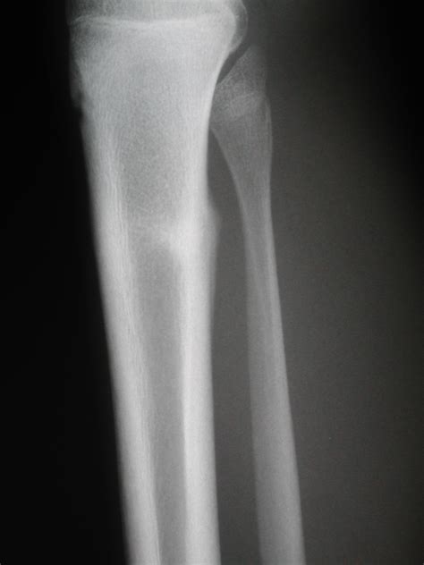 Depressed Fracture X Ray