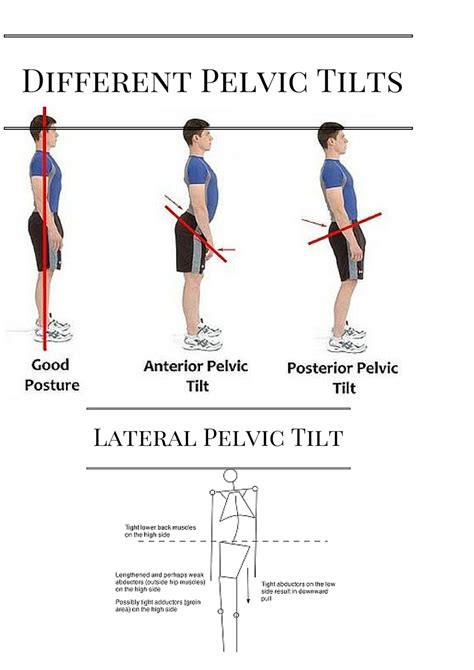 Posterior Pelvic Tilt Cause Symptom Treatment Physiotherapy Exercise