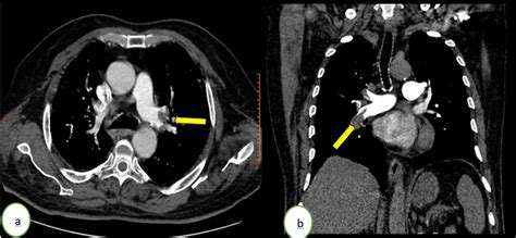 Cureus Bilateral Pulmonary Embolism In Patients Recovered From