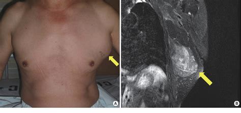 Figure 1 From Liposarcoma In The Axilla Developed From A Longstanding