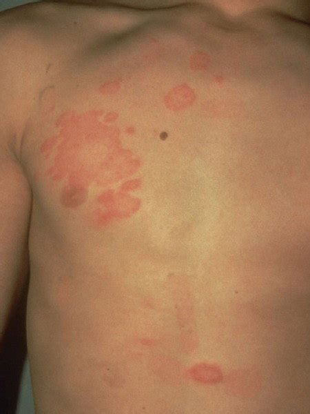 Fungal Infections Of The Skin Dermatologist In Sonoma Ca Sonoma