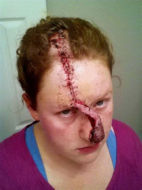 Have any red, scaly lesions that look like this? Woman's Pimple Turned Out to Be Skin Cancer - Marisha ...