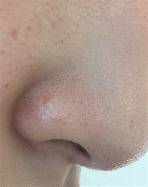 Skin Concern Ive Had This Little Hard Gray Bump On My Nostril For 2