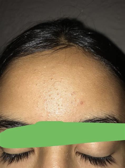 Tiny Bumps On Forehead General Acne Discussion Acne Org