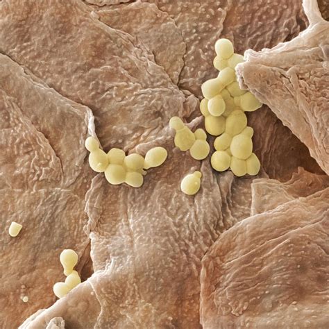 These infections are quite common and often cause an irritating rash. Yeast Fungus Skin Infection, Sem Photograph by Power And Syred