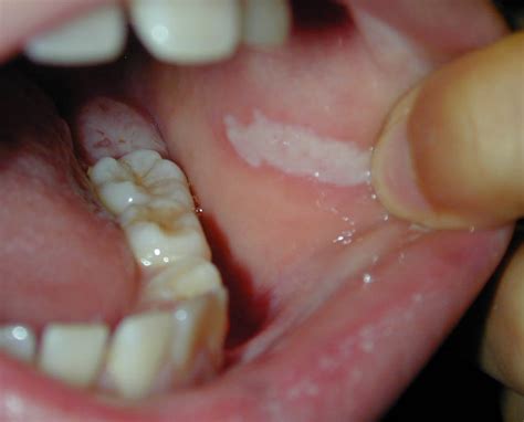 Cancer Of The Oral Cavity Mucous Membrane Cheeks Palate Gums