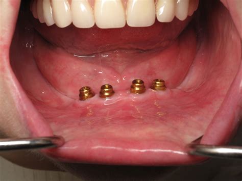 Implant Supported Dentures Locator Dentures