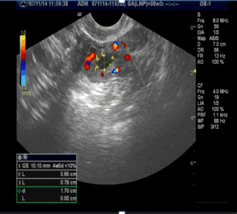 At this stage in your pregnancy, you're just under one month (0m3w) pregnant. Transvaginal ultrasound image of an ectopic tubal ...