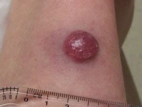 Merkel cell carcinoma should be considered in any tumour with aeiou clinical features, which are present in about 90% of patients with the disease. Merkel cell carcinoma | DermNet NZ
