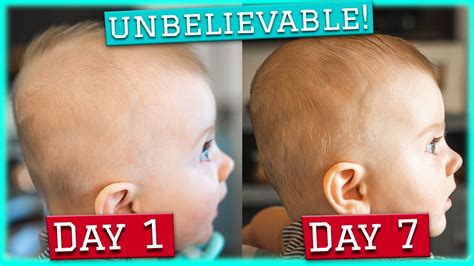 Plagiocephaly 1 Week Update Using Baby Helmetdoc Band 1 Week Youtube