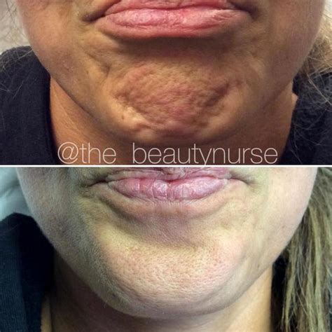 Botox On Chin Dimples Photos Facial Injections Info Prices Photos