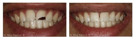 Benefits Of Composite Bonding Or White Filling London Specialist Dentists