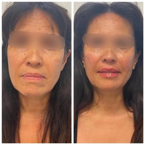 Cheek Augmentation Botox Wellington Wellington Cosmetic Clinic