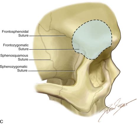 Supraorbital Osteotomy Eyelid And Eyebrow Incisions Neupsy Key