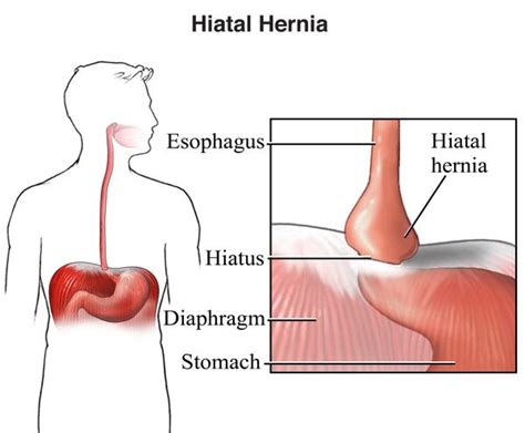 Hiatal Hernia Treatment In New Jersey Thoracic Care