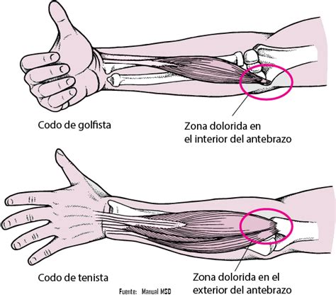 Lesiones Del Codo Codo De Tenista Y Codo De Golfista