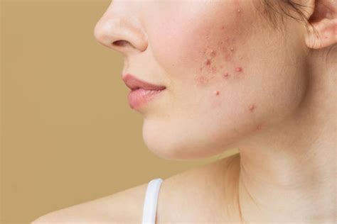 How To Treat Red Spots On Lips