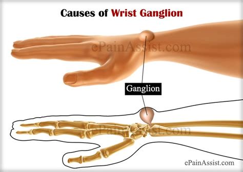 Wrist Ganglioncausessymptomstreatmentexercisestypes