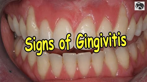 Gingivitis Symptoms Early Signs And Symptoms Of Gingivitis Youtube