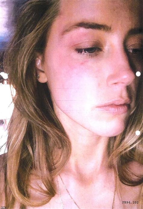 New Pictures Show Amber Heards Bruised Face After Johnny Depp Threw