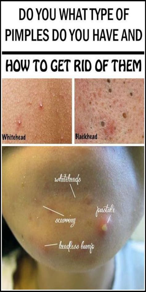 What Type Of Pimples You Have And How To Get Rid Of Them Sweet Oh Joy
