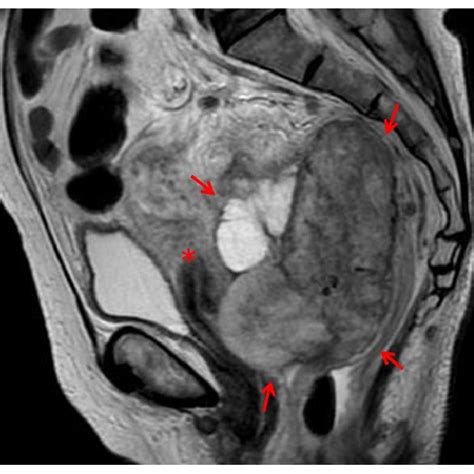 T2 Weighed Magnetic Resonance Imaging Of The Pelvis Revealed A Large