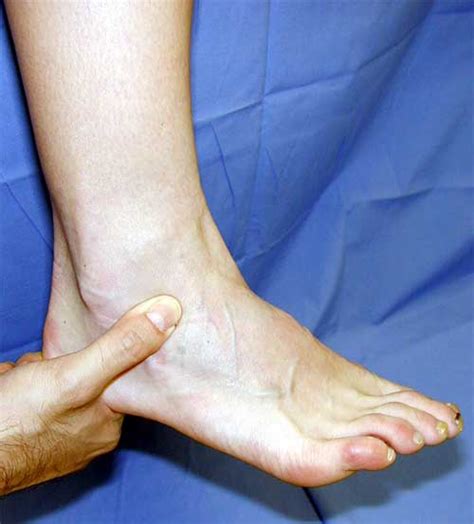 Ankle Disorders Causes Symptoms Treatment Ankle Disorders