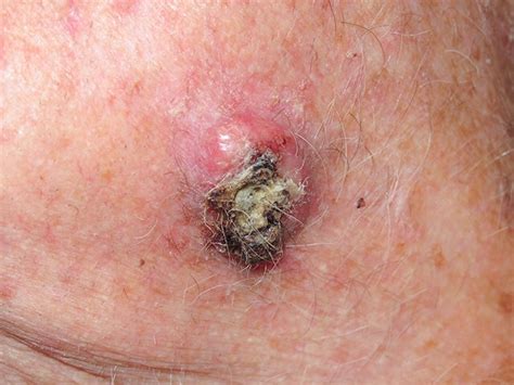 Skin Cancer Pictures Most Common Skin Cancer Types With Images