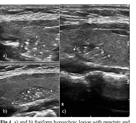 Intrathyroidal Ectopic Thymus In Children A Sonographic Survey