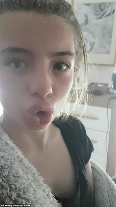 Mother In Stitches As Teenage Daughter Gets Stuck With Duck Lips For