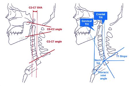 Schematic Drawings Of The Conventional Cervical Alignment Parameters