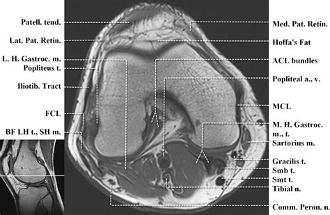 Knee Muscle Anatomy Mri These Are Essential Structures To Evaluate In