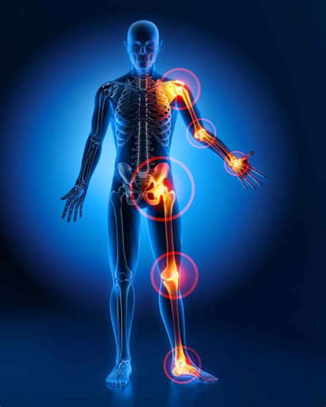 Joint Injections For Osteoarthritis Precautions And Efficacy