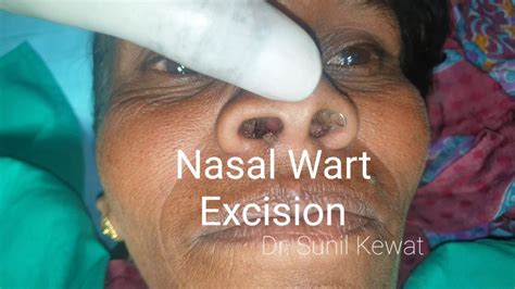 Pictures Of Warts Inside Nose