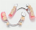 Prótesis removible parcial – Centro Odontológico Alfadent