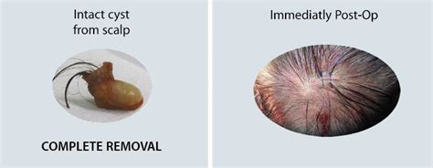 Cyst Removal Sebaceous Cyst Removal Treatment In London