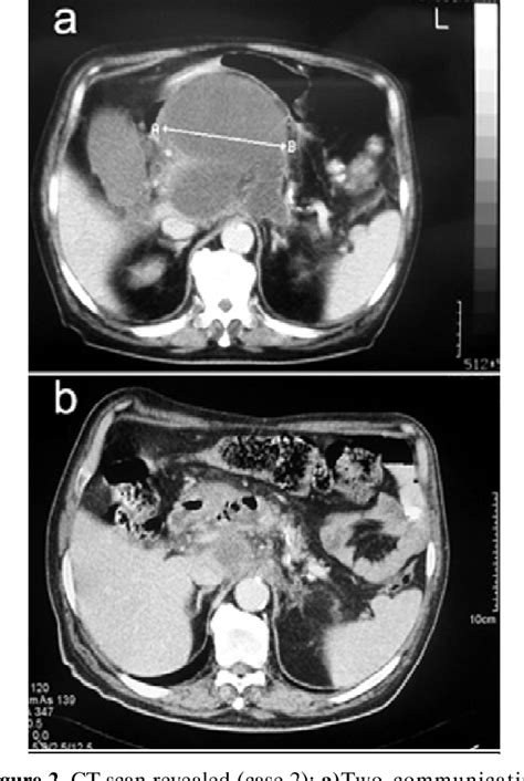 Figure From Endoscopic Drainage Of Pancreatic Pseudocysts Semantic