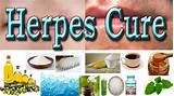 Holistic Treatment For Herpes Simple  2 Photos