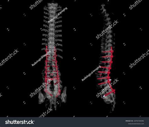 Ct Scan Thoracic Lumbar Spine 3d Stock Illustration 2375734391