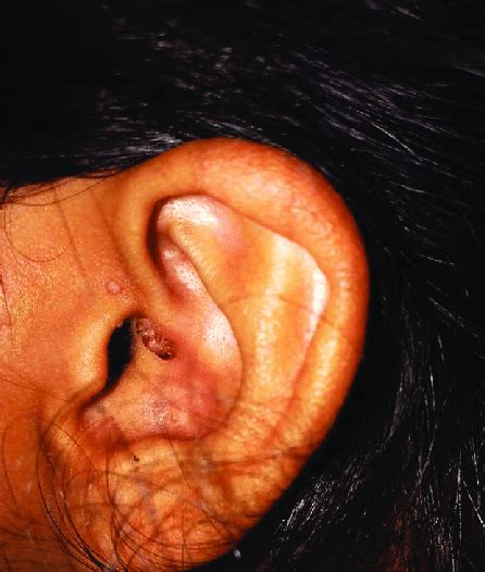 Wart On Ear Slightly Reduced Second Visit Download Scientific Diagram