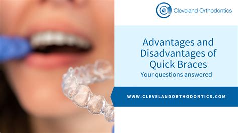 Advantages And Disadvantages Of Quick Braces Your Questions Answered Cleveland Orthodontics