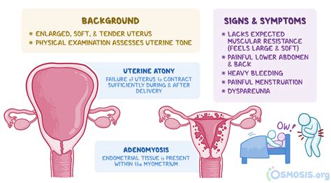 Boggy Uterus What Is It Causes Treatment And More Osmosis