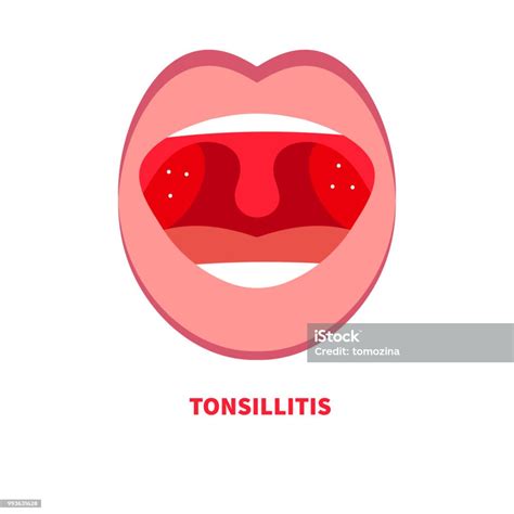 Tonsillitis Angina Sore Throat Stock Illustration Download Image Now