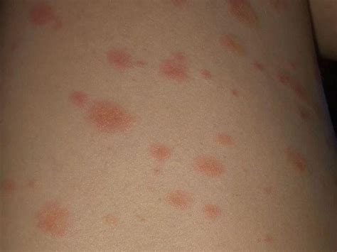 Rashes Can Occur After Covid Vaccine But Dermatologists Say Dont Worry