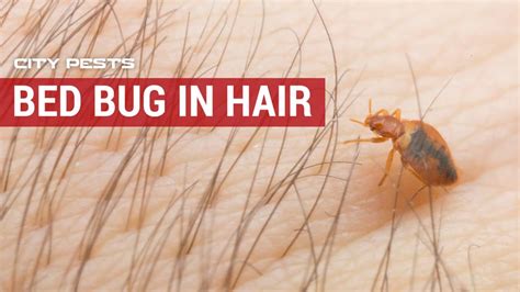 Bed Bugs In Hair Symptoms Pictures And Treatment For Bugs In Hair