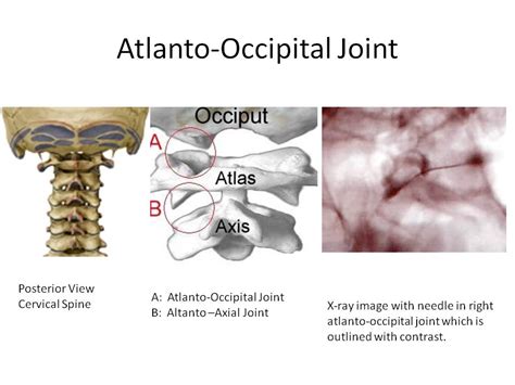 Occipital Neuralgia And Atrial Flutter Connection Occipital Lymph