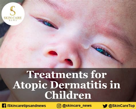Treatments For Atopic Dermatitis In Children