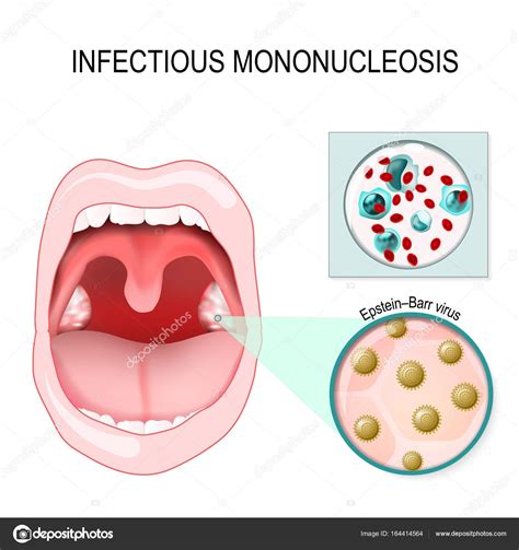 Mononucleosis Infecciosa Dr José Luis Vázquez