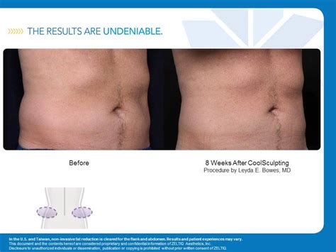 Coolsculpting Nonsurgical Fat Freezing Treatment Zeltiq Before After Photos Body Contouring