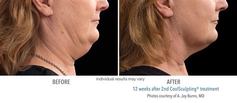 Coolsculpting Before And After Fat Freezing Body Transformations